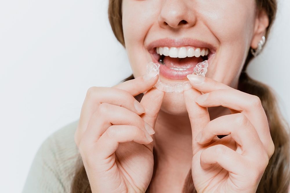 Woman placing a clear aligner on her teeth